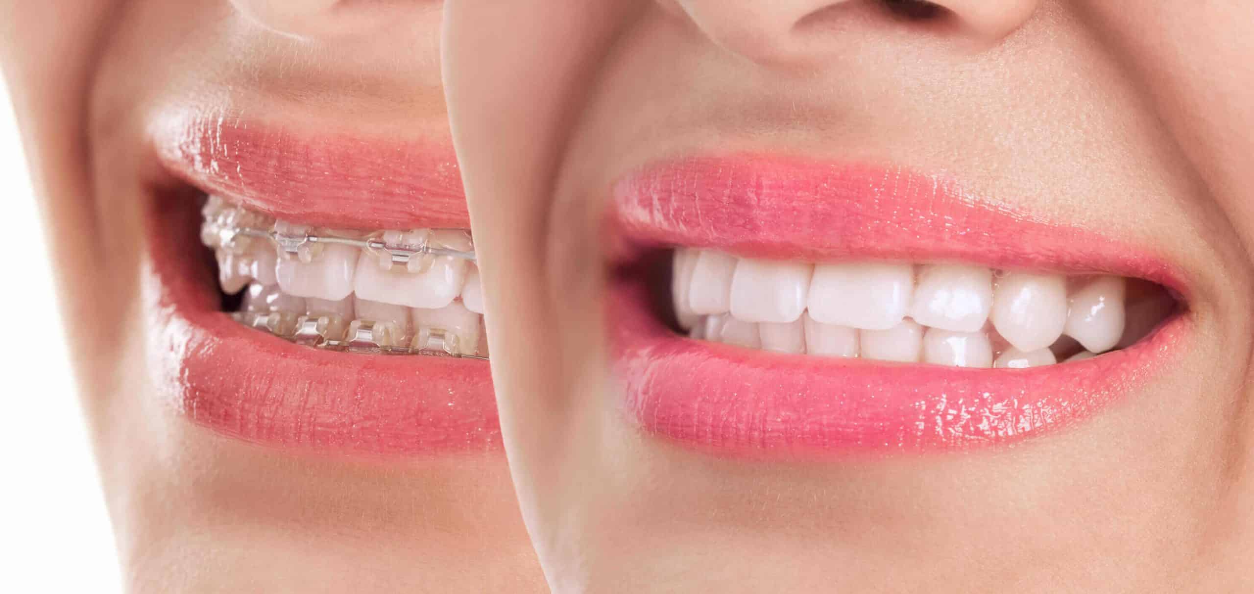 Braces Care Guide  Frequently Asked Questions About Braces