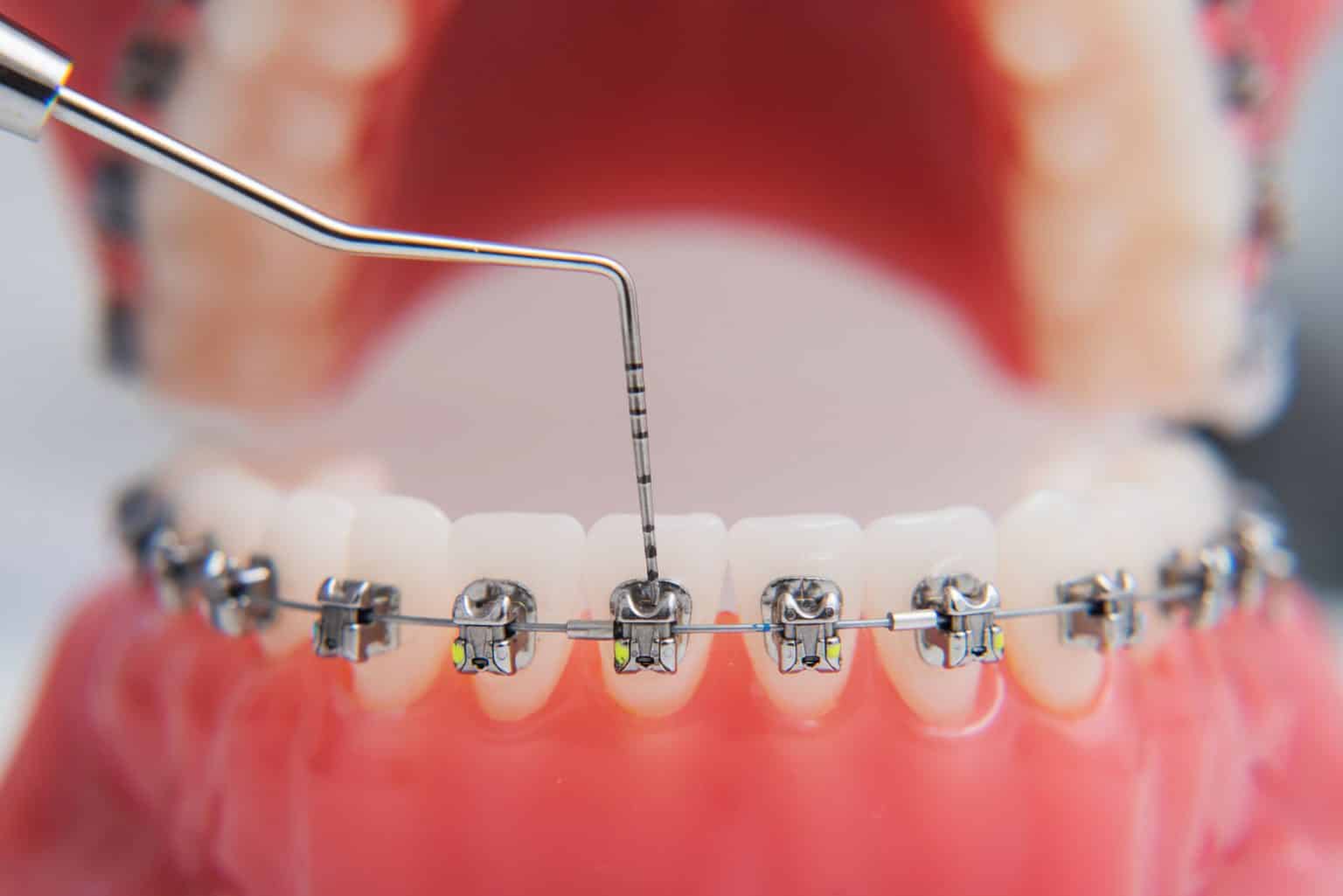 How Do Braces Move Teeth? How Do Braces Work?