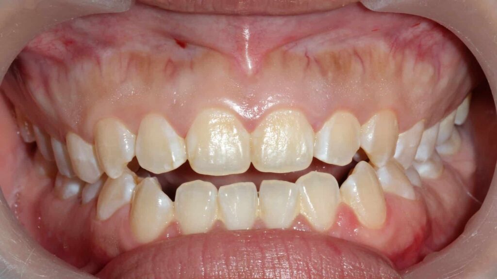 What Is an Open Bite SOS Braces